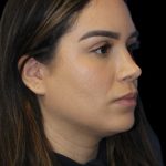 Primary Rhinoplasty Before & After Patient #856