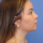 Primary Rhinoplasty Before & After Patient #77