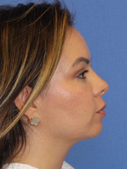 Primary Rhinoplasty Before & After Patient #77