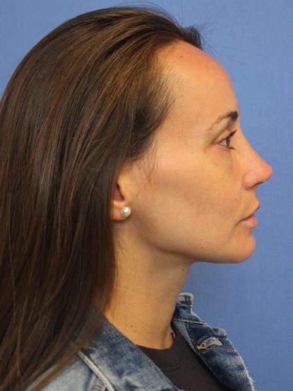 Primary Rhinoplasty Before & After Patient #76