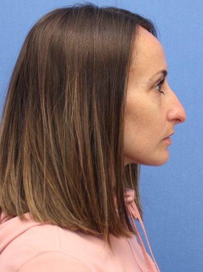 Primary Rhinoplasty Before & After Patient #76