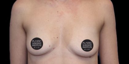 Breast Augmentation Before & After Patient #497