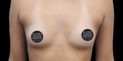 Breast Augmentation Before & After Patient #499