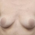 Breast Augmentation Before & After Patient #500