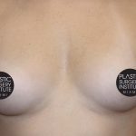 Breast Augmentation Before & After Patient #501