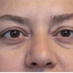Blepharoplasty Before & After Patient #387