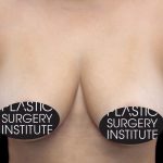 Breast Lift Before & After Patient #536
