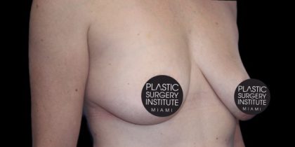 Breast Lift Before & After Patient #537