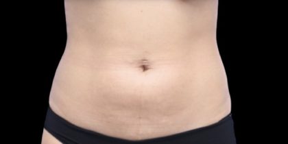 Liposuction Before & After Patient #598