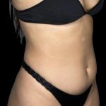 Liposuction Before & After Patient #599