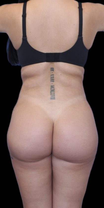 Liposuction Before & After Patient #600