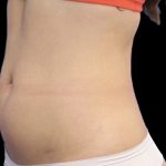 Liposuction Before & After Patient #602