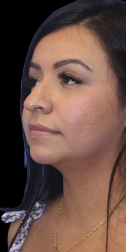 Primary Rhinoplasty Before & After Patient #826