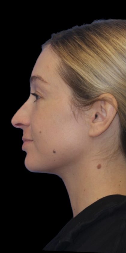 Primary Rhinoplasty Before & After Patient #839