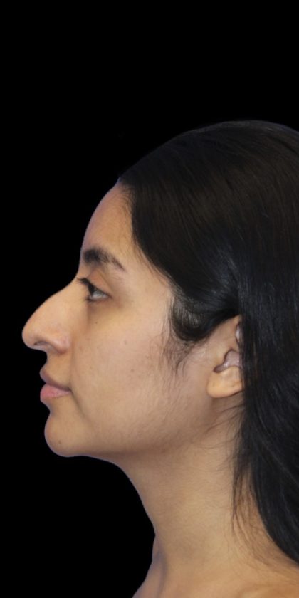 Primary Rhinoplasty Before & After Patient #840