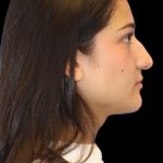 Primary Rhinoplasty Before & After Patient #841