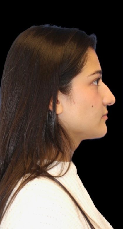 Primary Rhinoplasty Before & After Patient #841