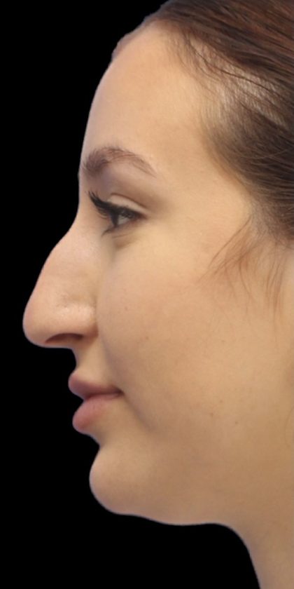 Primary Rhinoplasty Before & After Patient #842
