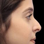 Primary Rhinoplasty Before & After Patient #854