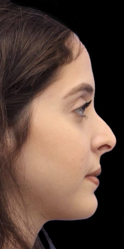 Primary Rhinoplasty Before & After Patient #854