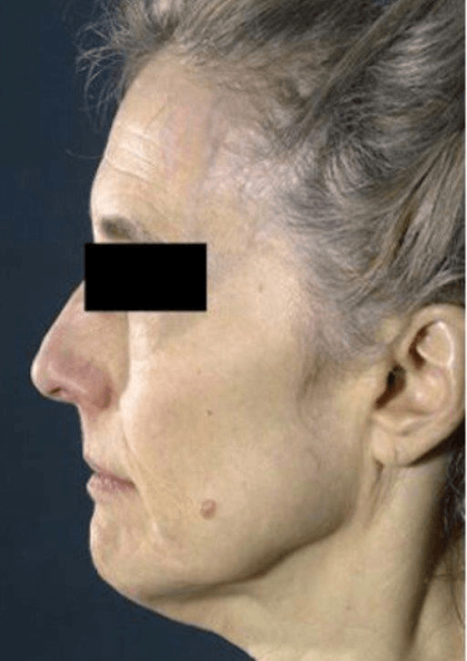 Neck Lift Before & After Patient #631