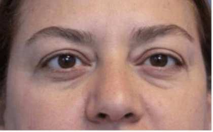 Blepharoplasty Before & After Patient #387