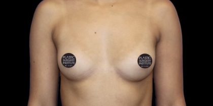 Breast Augmentation Before & After Patient #490
