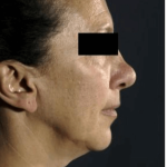 Neck Lift Before & After Patient #633