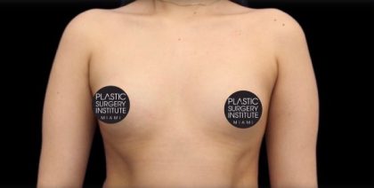 Breast Augmentation Before & After Patient #492