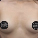 Breast Augmentation Before & After Patient #493