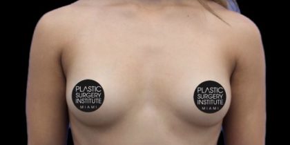 Breast Augmentation Before & After Patient #493