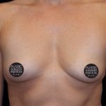Breast Augmentation Before & After Patient #496