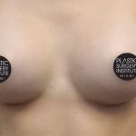 Breast Augmentation Before & After Patient #424