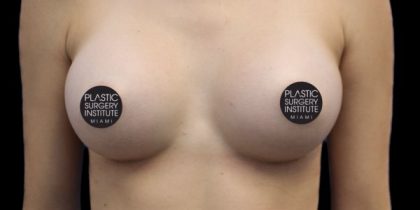Breast Augmentation Before & After Patient #424