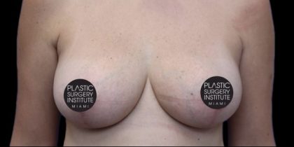 Breast Lift Before & After Patient #534