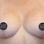 Breast Lift Before & After Patient #535