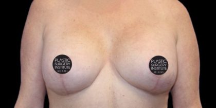 Breast Lift Before & After Patient #535