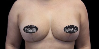 Breast Lift Before & After Patient #536