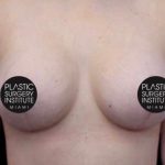 Breast Lift Before & After Patient #539