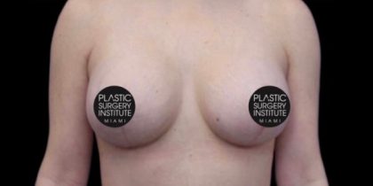 Breast Lift Before & After Patient #539