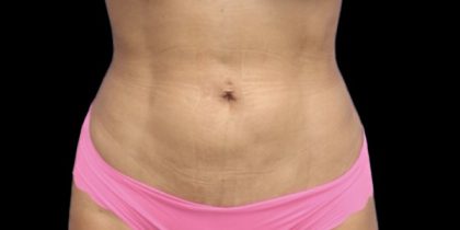 Liposuction Before & After Patient #598