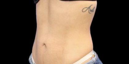 Liposuction Before & After Patient #602