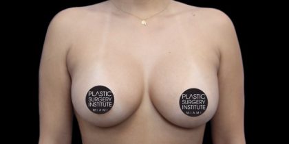 Breast Augmentation Before & After Patient #426