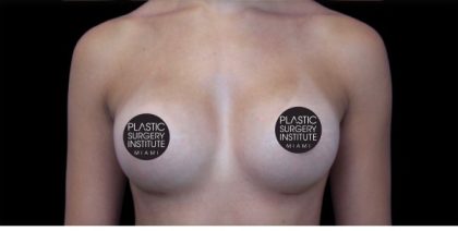 Breast Augmentation Before & After Patient #491