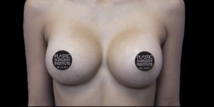 Breast Augmentation Before & After Patient #423
