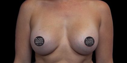 Breast Augmentation Before & After Patient #496