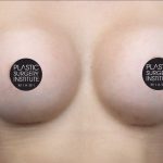Breast Augmentation Before & After Patient #499