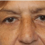 Blepharoplasty Before & After Patient #388