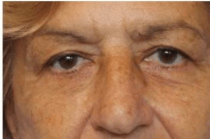 Blepharoplasty Before & After Patient #388