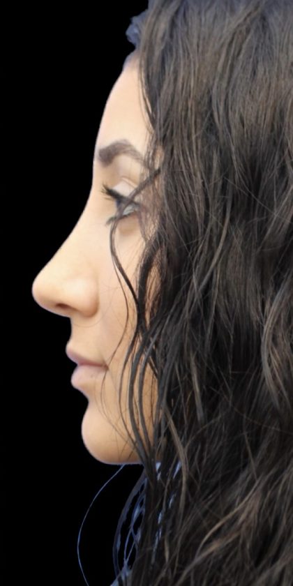 Primary Rhinoplasty Before & After Patient #822